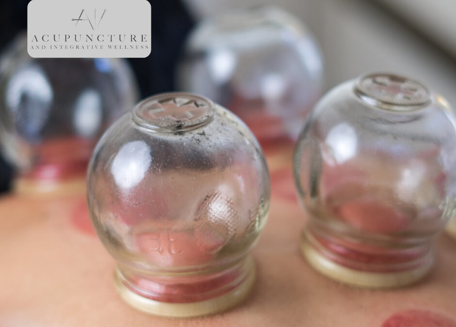 Finding Balance in La Vale, MD: Your Guide to Acupuncture, Cupping, and Integrative Wellness