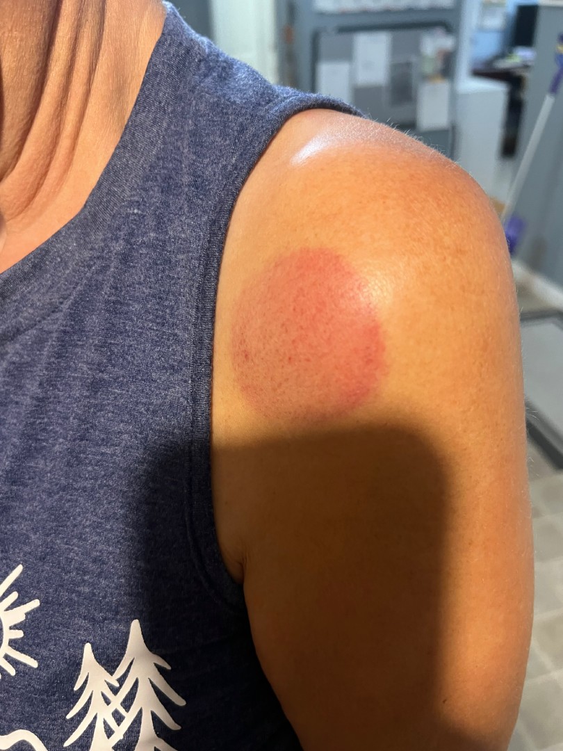 Services - Cupping Therapy Image 2